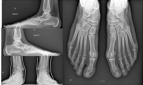 Radiographie standard du pied en charge