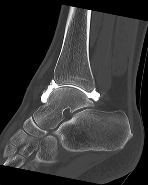 Image d'un arthroscanner de cheville