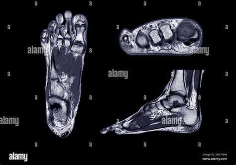 Image d'une IRM du pied mettant en évidence une lésion tendineuse