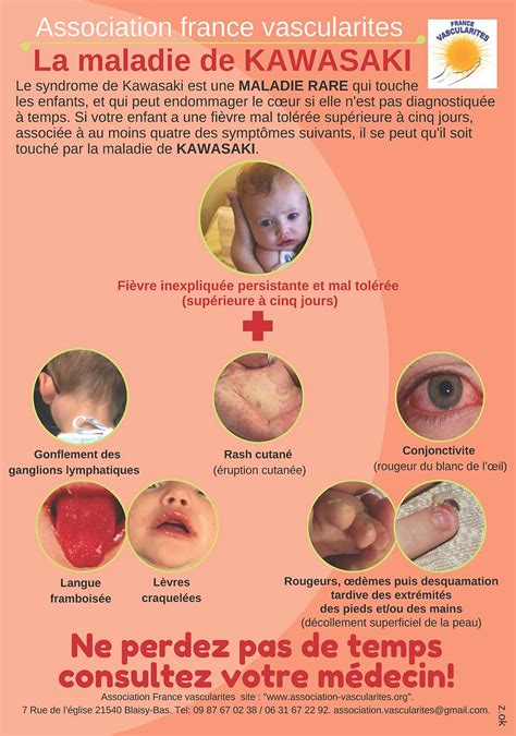 Illustration des symptômes clés de la maladie de Kawasaki : langue framboisée, yeux rouges, éruption cutanée