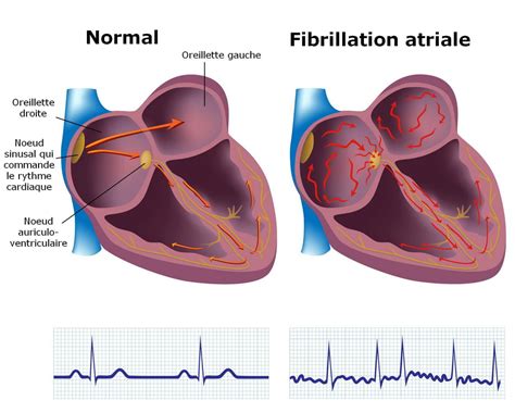 Schéma illustrant le principe de l'ablation par cathéter pour traiter la fibrillation auriculaire.