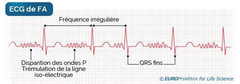 Image d'un électrocardiogramme montrant le tracé typique d'une fibrillation auriculaire.
