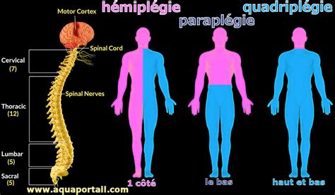 Illustration comparative entre hémiparésie et hémiplégie